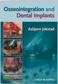 Osseointegration and Dental Implants